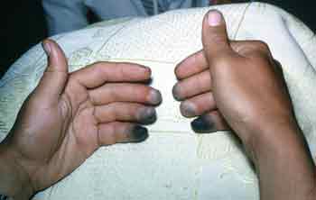 Apsaldētie pirksti